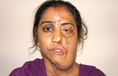Fotografía real de mujer atacada con ácido
