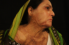 Fotografía real de mujer atacada con ácido